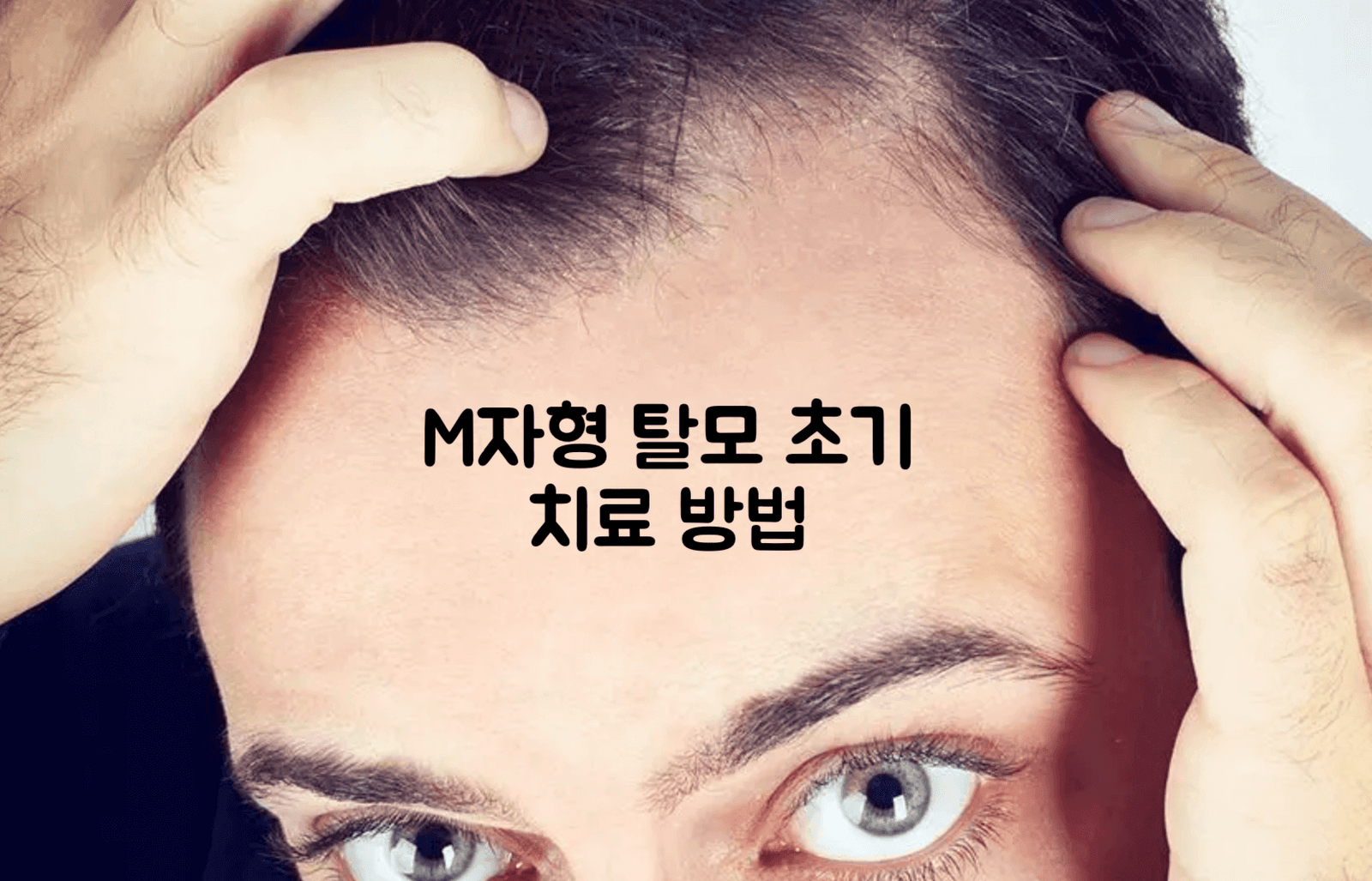 M자 탈모 건강보험 적용, 정말 한 달 1만 원대로 가능할까? 2026년 최신 현황 완벽 정리! 11 섹션 1 이미지